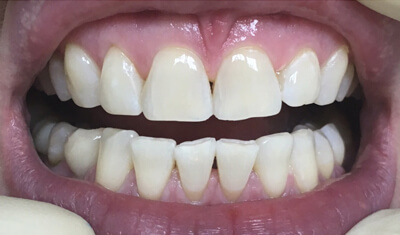 Лечение кисты зуба без удаления нижний новгород thumbnail
