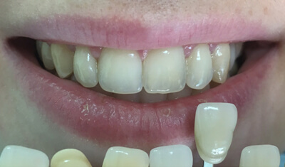 Лечение зубов седация нижний новгород thumbnail